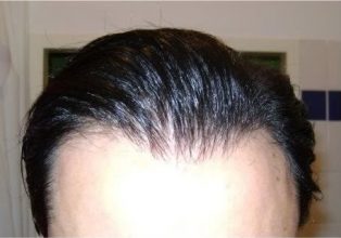 Hair-transplant-real-results-turkey (7)