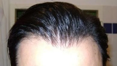 Hair-transplant-real-results-turkey (7)