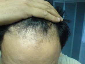 Hair-transplant-real-results-turkey (8)