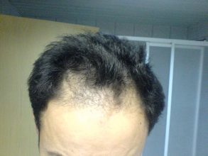 Hair-transplant-real-results-turkey (9)