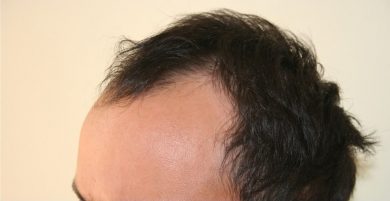 best-fue-hair-transplant (1)