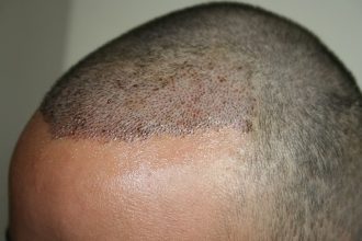 best-fue-hair-transplant (10)