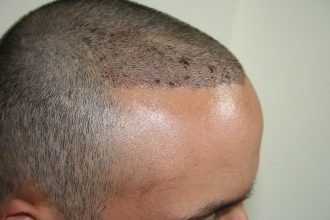 best-fue-hair-transplant (11)