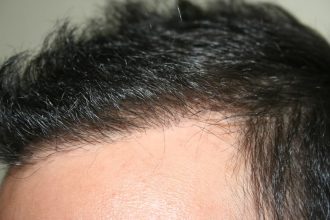 best-fue-hair-transplant (13)