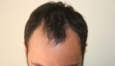 best-fue-hair-transplant (14)