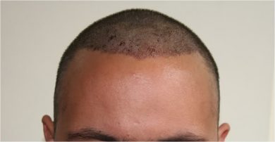 best-fue-hair-transplant (2)