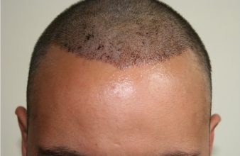 best-fue-hair-transplant (3)