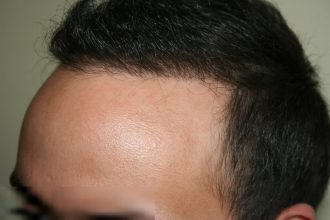 best-fue-hair-transplant (6)