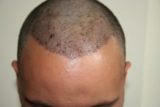 best-fue-hair-transplant (8)