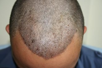 best-fue-hair-transplant (9)