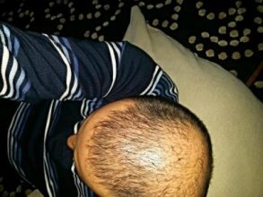 dr-kul-3500-grafts (15)