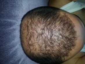 dr-kul-3500-grafts (16)