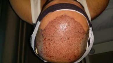 dr-kul-3500-grafts (6)