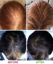 hair-laser-growth (1)