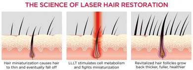 hair-laser-growth (6)
