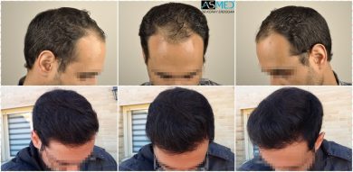 hair-transplant-in-turkey-acibadem (1)