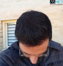 hair-transplant-in-turkey-acibadem (10)