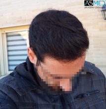 hair-transplant-in-turkey-acibadem (12)