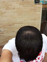 hair-transplant-in-turkey-acibadem (13)