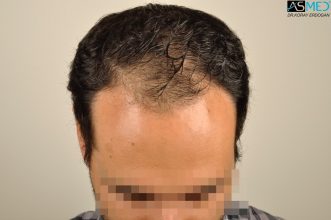 hair-transplant-in-turkey-acibadem (2)