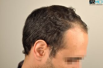 hair-transplant-in-turkey-acibadem (3)