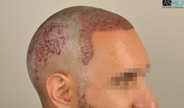 hair-transplant-in-turkey-acibadem (6)
