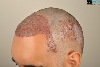 hair-transplant-in-turkey-acibadem (7)