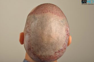 hair-transplant-in-turkey-acibadem (8)