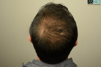 hair-transplant-in-turkey-acibadem (9)