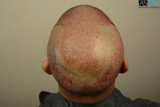 hair-transplant-in-turkey-asmed (11)
