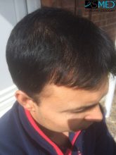 hair-transplant-in-turkey-asmed (12)