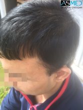 hair-transplant-in-turkey-asmed (13)