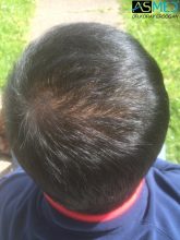 hair-transplant-in-turkey-asmed (2)