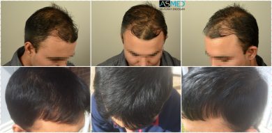 hair-transplant-in-turkey-asmed (3)