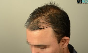 hair-transplant-in-turkey-asmed (6)