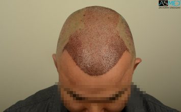 hair-transplant-in-turkey-asmed (8)