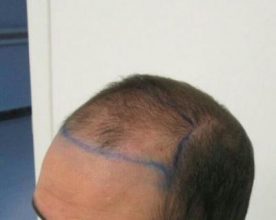 dr-kul-hair-transplant (1)