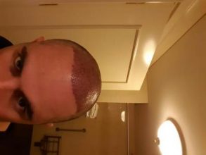 dr-kul-hair-transplant (12)