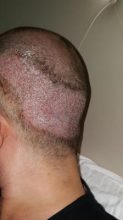 dr-kul-hair-transplant (13)