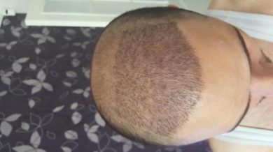 dr-kul-hair-transplant (15)