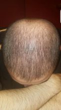 dr-kul-hair-transplant (16)