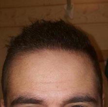 dr-kul-hair-transplant (17)
