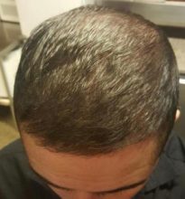 dr-kul-hair-transplant (18)