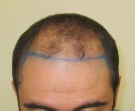 dr-kul-hair-transplant (2)