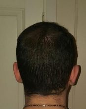 dr-kul-hair-transplant (20)