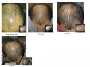 dr-kul-hair-transplant (21)
