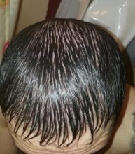dr-kul-hair-transplant (22)