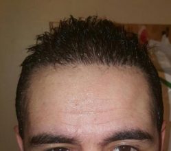 dr-kul-hair-transplant (23)