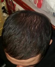 dr-kul-hair-transplant (26)