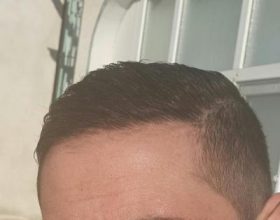 dr-kul-hair-transplant (27)